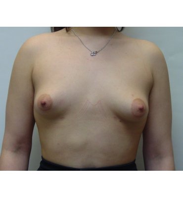 tuberous breast pre
